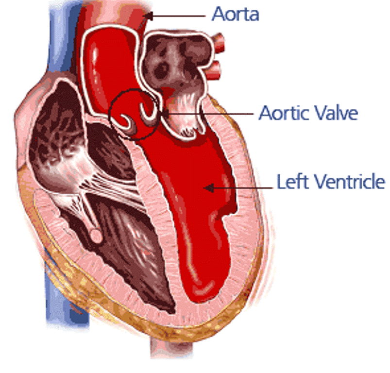 aortic-valve-stenosis-heart-1|aortic-stenosispicture-275|AS